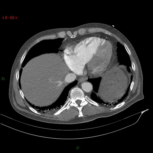 Abdominal aortic aneurysm rupture with aortocaval fistula (Radiopaedia 14897-14841 Axial C+ arterial phase 60).jpg