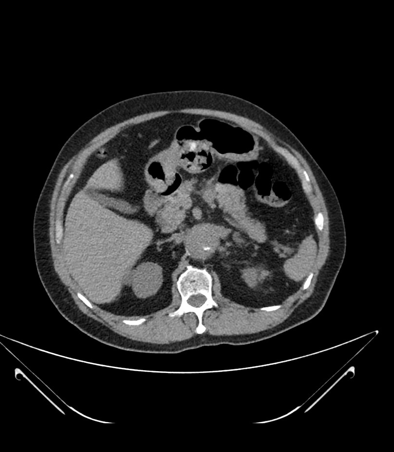 Abdominal aortic aneurysm with thrombus fissuration (Radiopaedia 46218-50618 Axial non-contrast 16).jpg
