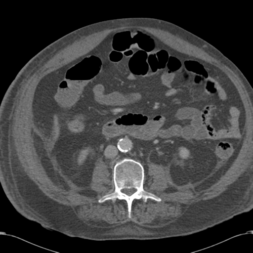 Abdominal hematoma (Radiopaedia 33614-34715 Axial C+ portal venous phase 66).png