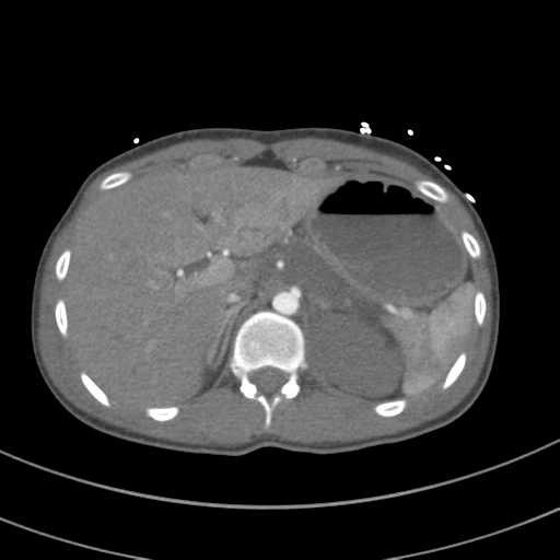 File:Abdominal multi-trauma - devascularised kidney and liver, spleen and pancreatic lacerations (Radiopaedia 34984-36486 Axial C+ arterial phase 88).png