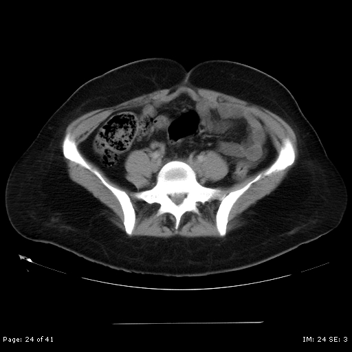 File:Abdominal wall endometriosis (Radiopaedia 25723-25885 Axial C+ portal venous phase 24).jpg