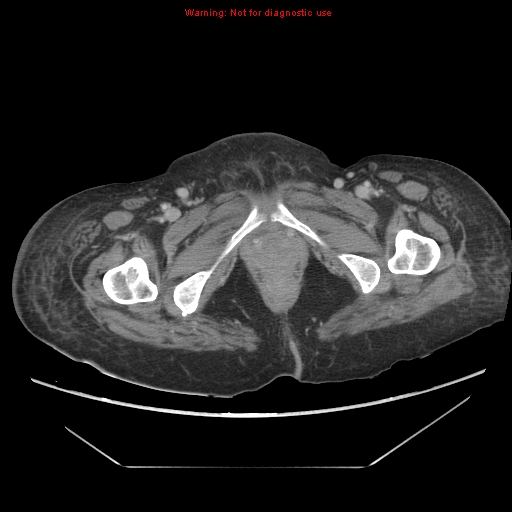 File:Abdominal wall hematoma (Radiopaedia 9427-10112 Axial C+ portal venous phase 112).jpg