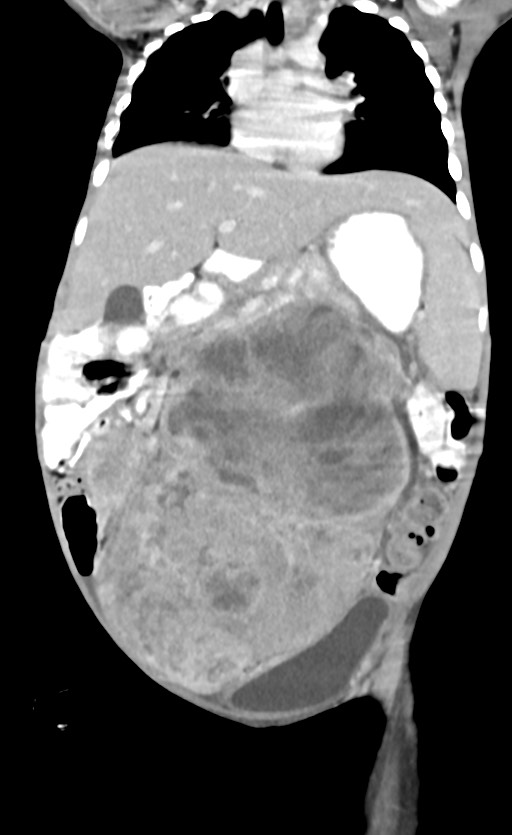 Abdominopelvic rhabdomyosarcoma (Radiopaedia 78356-90984 Coronal C+ portal venous phase 41).jpg