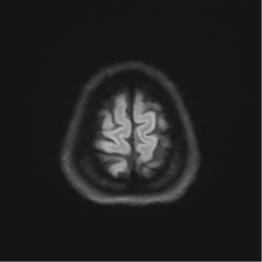File:Abducens nerve palsy (Radiopaedia 51069-56648 Axial DWI 52).png