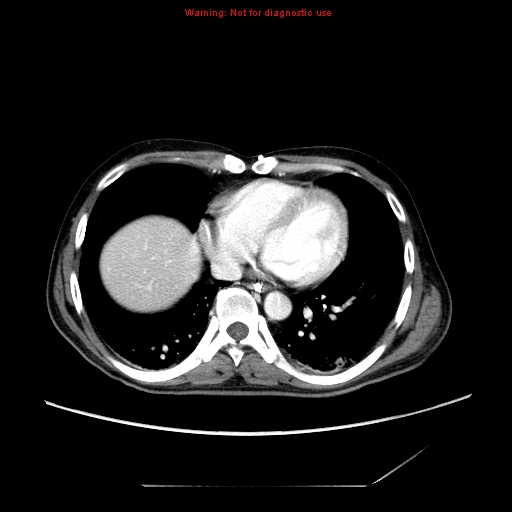 File:Aberrant right subclavian artery (Radiopaedia 9379-10071 Axial C+ arterial phase 45).jpg