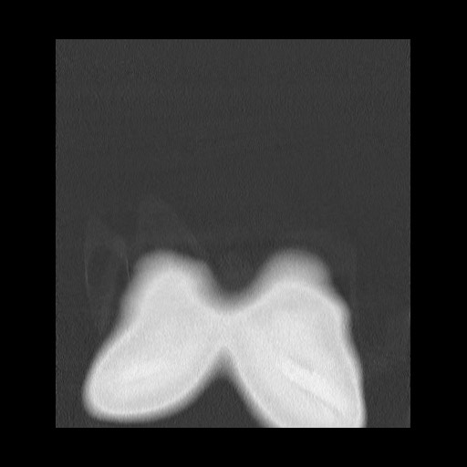 Accessory left horizontal fissure with lingular pneumonia (Radiopaedia 53763-59843 Coronal lung window 2).jpg