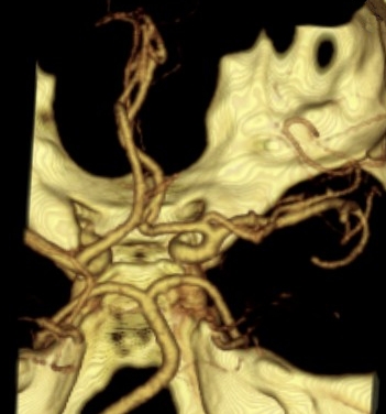 File:Accessory middle cerebral artery (Radiopaedia 35944).jpg