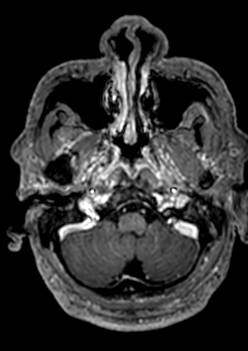 Accessory middle cerebral artery (Radiopaedia 73114-83828 Axial T1 C+ 165).jpg