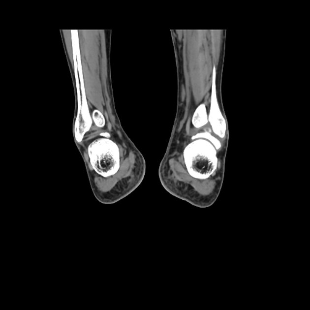 Accessory soleus muscle (Radiopaedia 61069-68943 Coronal non-contrast 54).jpg