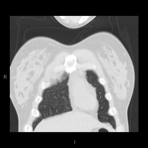 Accidental foreign body aspiration (seamstress needle) (Radiopaedia 77740-89983 Coronal lung window 57).jpg