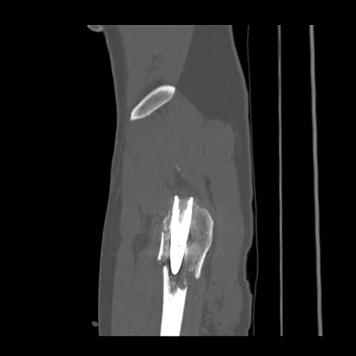 Acetabular and ilial fractures (Radiopaedia 59084-66378 Sagittal bone window 94).jpg