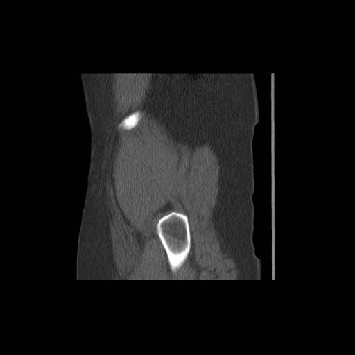 File:Acetabular fracture (Radiopaedia 13193-13212 Sagittal bone window 5).jpg
