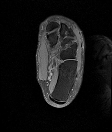 File:Achilles tendon tear (Radiopaedia 77615-89819 Axial PD fat sat 23).jpg