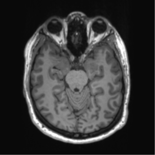 File:Achondroplasia (Radiopaedia 65109-74105 Axial T1 36).png