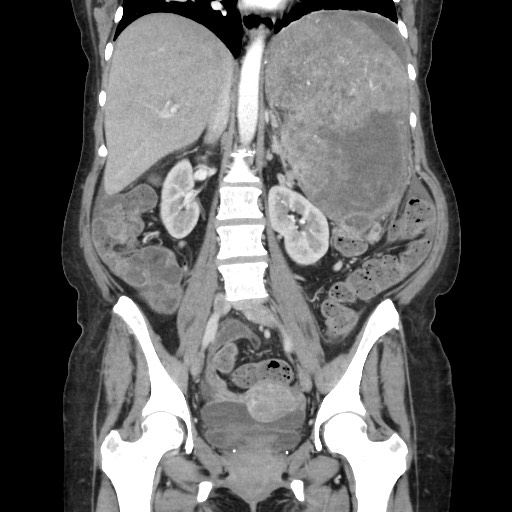 File:Acinar cell carcinoma of the pancreas (Radiopaedia 75442-86669 Coronal C+ portal venous phase 73).jpg