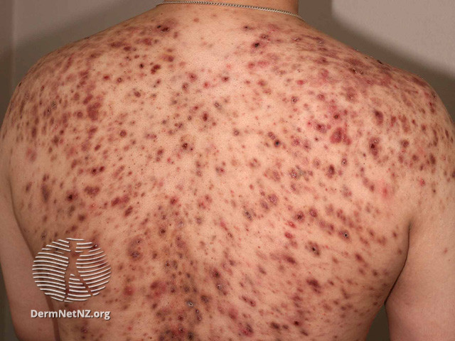 File:Acne affecting the back images (DermNet NZ acne-acne-back-194).jpg