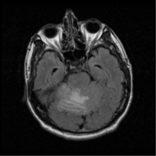 File:Acoustic schwannoma (Radiopaedia 39170-41387 Axial FLAIR 7).png