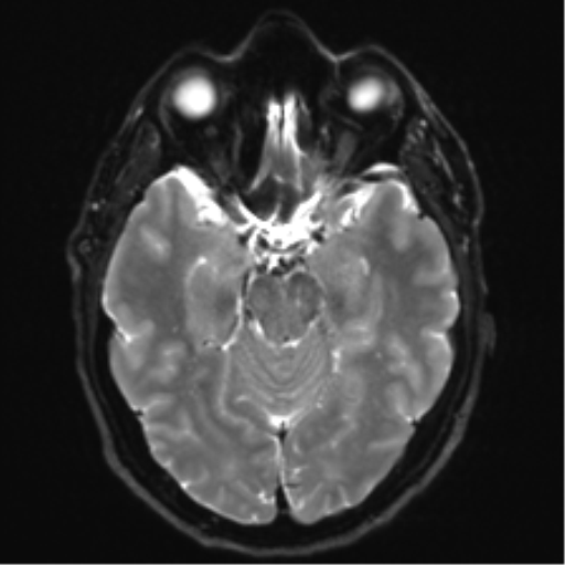 Acoustic schwannoma (Radiopaedia 50846-56358 Axial DWI 11).png