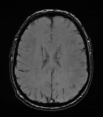Acoustic schwannoma (Radiopaedia 50846-56358 Axial SWI 60).png
