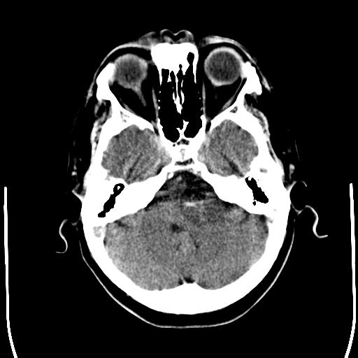 File:Acoustic schwannoma - cystic (Radiopaedia 29487-29980 AXIAL THICK non-contrast 7).jpg