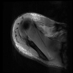 File:Acromioclavicular joint dislocation (Radiopaedia 14218-14076 Axial Gradient Echo 5).jpg