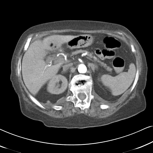 File:Active bleeding from duodenal ulcer with embolization (Radiopaedia 34216-35481 Axial C+ arterial phase 20).png