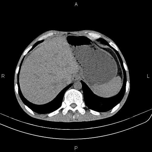 Active crohn disease (Radiopaedia 87133-103397 Axial non-contrast 15).jpg