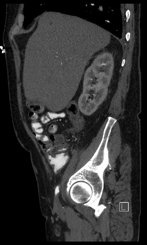 Active lower gastrointestinal bleeding - diverticular (Radiopaedia 61203-69106 Sagittal C+ arterial phase 118).jpg