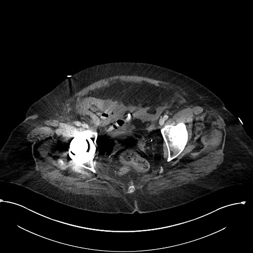 File:Active renal extravasation with large subcapsular and retroperitoneal hemorrhage (Radiopaedia 60975-68796 Axial 312).jpg