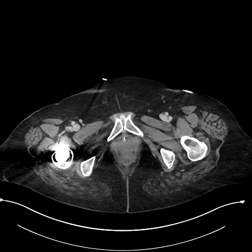 File:Active renal extravasation with large subcapsular and retroperitoneal hemorrhage (Radiopaedia 60975-68796 Axial 344).jpg