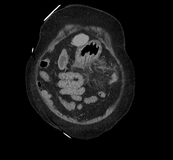 Active renal extravasation with large subcapsular and retroperitoneal hemorrhage (Radiopaedia 60975-68796 Coronal C+ portal venous phase 32).jpg