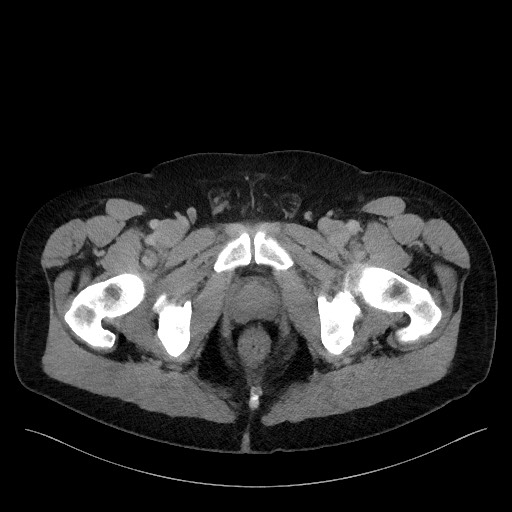 File:Acute-on-chronic pancreatitis (Radiopaedia 67286-76656 Axial C+ portal venous phase 84).jpg