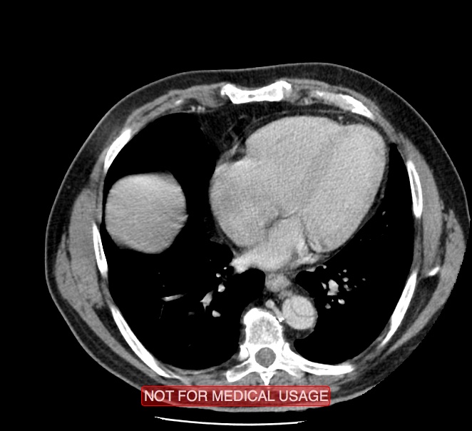 Acute aortic dissection - Stanford type A (Radiopaedia 40661-43285 Axial C+ portal venous phase 40).jpg