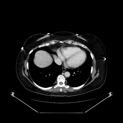 Acute appendicitis, heterotaxy syndrome (Radiopaedia 66884-76202 Axial C+ portal venous phase 12).jpg