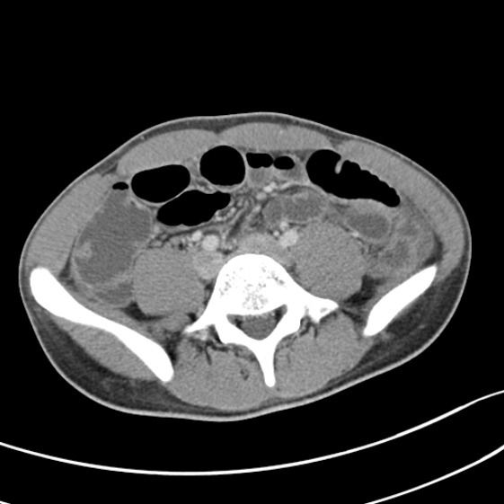 Acute appendicitis (Radiopaedia 32614-33572 Axial C+ portal venous phase 43).jpg