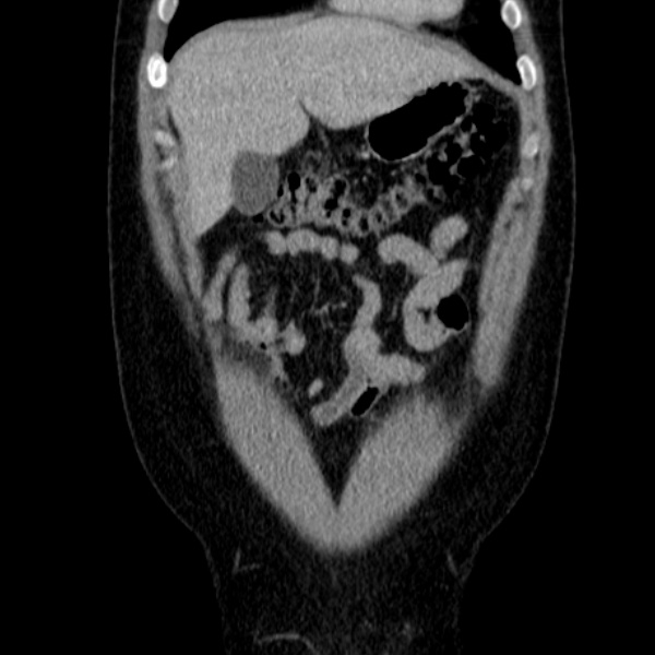 File:Acute appendicitis (Radiopaedia 38255-40270 Coronal C+ portal venous phase 21).jpg