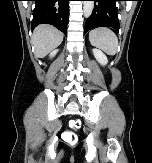 Acute appendicitis (Radiopaedia 77016-88960 Coronal C+ portal venous phase 73).jpg