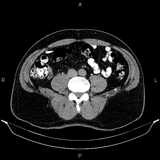 File:Acute appendicitis (Radiopaedia 84780-100240 Axial C+ delayed 66).jpg