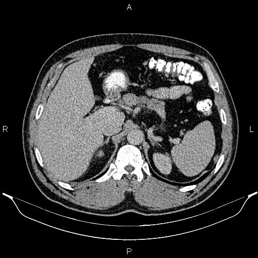 Acute appendicitis (Radiopaedia 84780-100240 Axial C+ portal venous phase 28).jpg