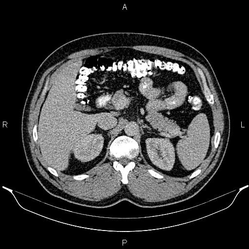 Acute appendicitis (Radiopaedia 84780-100240 Axial C+ portal venous phase 33).jpg