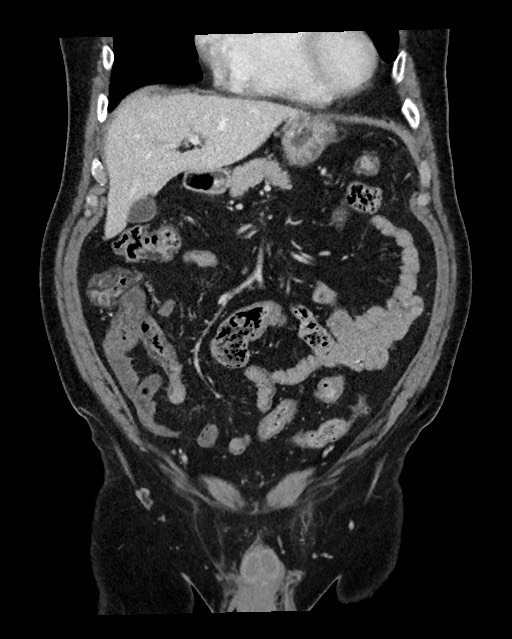 Acute appendicitis - large appendicoliths (Radiopaedia 61805-69820 Coronal C+ portal venous phase 44).jpg