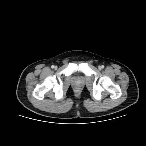 File:Acute appendicitis and COVID 19 pneumonia (Radiopaedia 76604-88380 Axial C+ portal venous phase 85).jpg