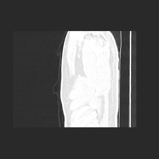 File:Acute appendicitis and COVID 19 pneumonia (Radiopaedia 76604-88380 Sagittal lung window 7).jpg