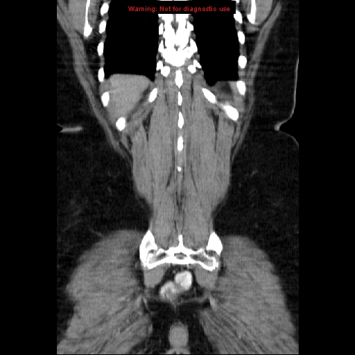 Acute appendicitis complicated by ovarian vein thrombophlebitis (Radiopaedia 16172-15851 Coronal C+ portal venous phase 70).jpg