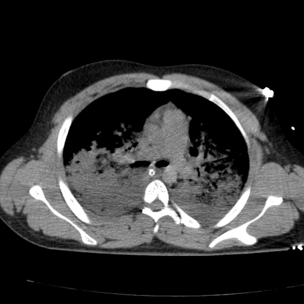 Acute aspiration pneumonitis (Radiopaedia 33605-34703 Axial non-contrast 40).jpg
