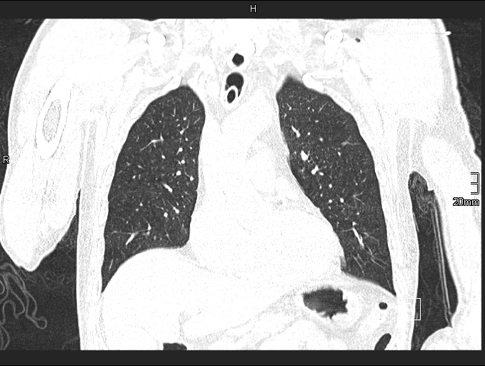 Acute aspiration pneumonitis (Radiopaedia 55642-62166 Coronal lung window 36).jpg