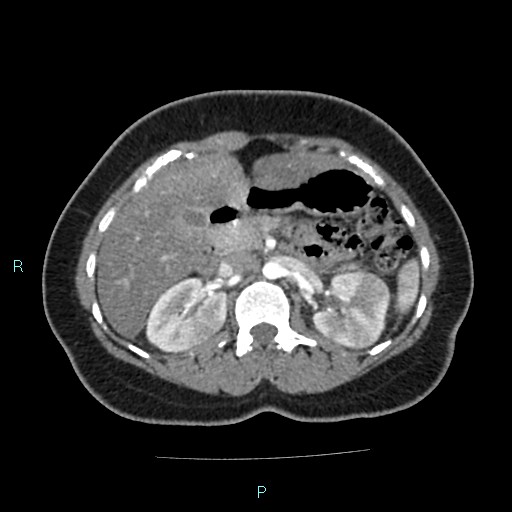 File:Acute bilateral pyelonephritis (Radiopaedia 37146-38881 Axial C+ arterial phase 67).jpg