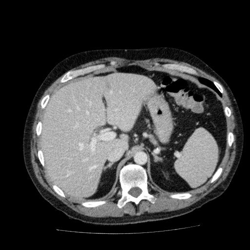 Acute cholecystitis and incidental left sided IVC (Radiopaedia 49352-54459 Axial C+ portal venous phase 43).jpg