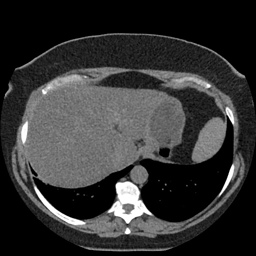 Acute cholecystitis and ureteric colic (Radiopaedia 42330-45444 Axial prone 3).jpg