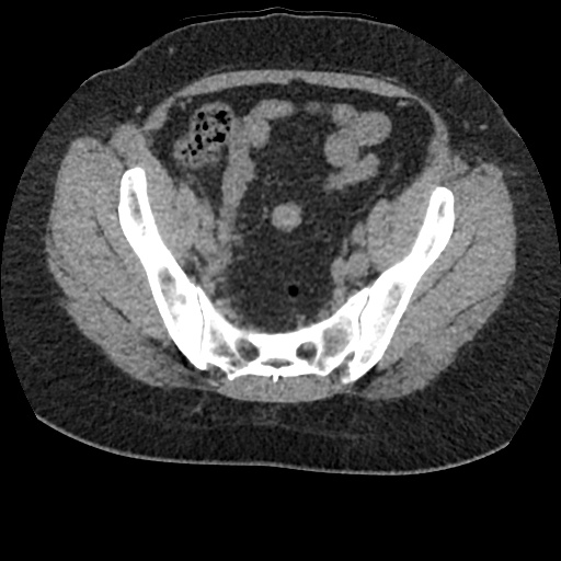 Acute cholecystitis and ureteric colic (Radiopaedia 42330-45444 Axial prone 87).jpg